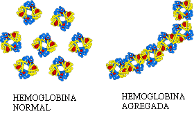 normal hemoglobin in normal red blood cell and clumped hemoglobin in sickle-shaped red blood cell